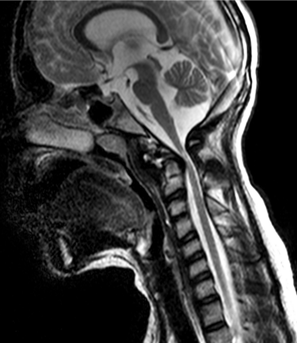 Imagen ilustrativa de descompresión de foramen magno