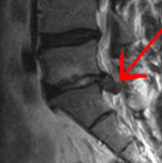 Imagen ilustrativa de hernia de núcleo pulposo