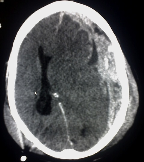 Imagen ilustrativa de hematoma intracerebral